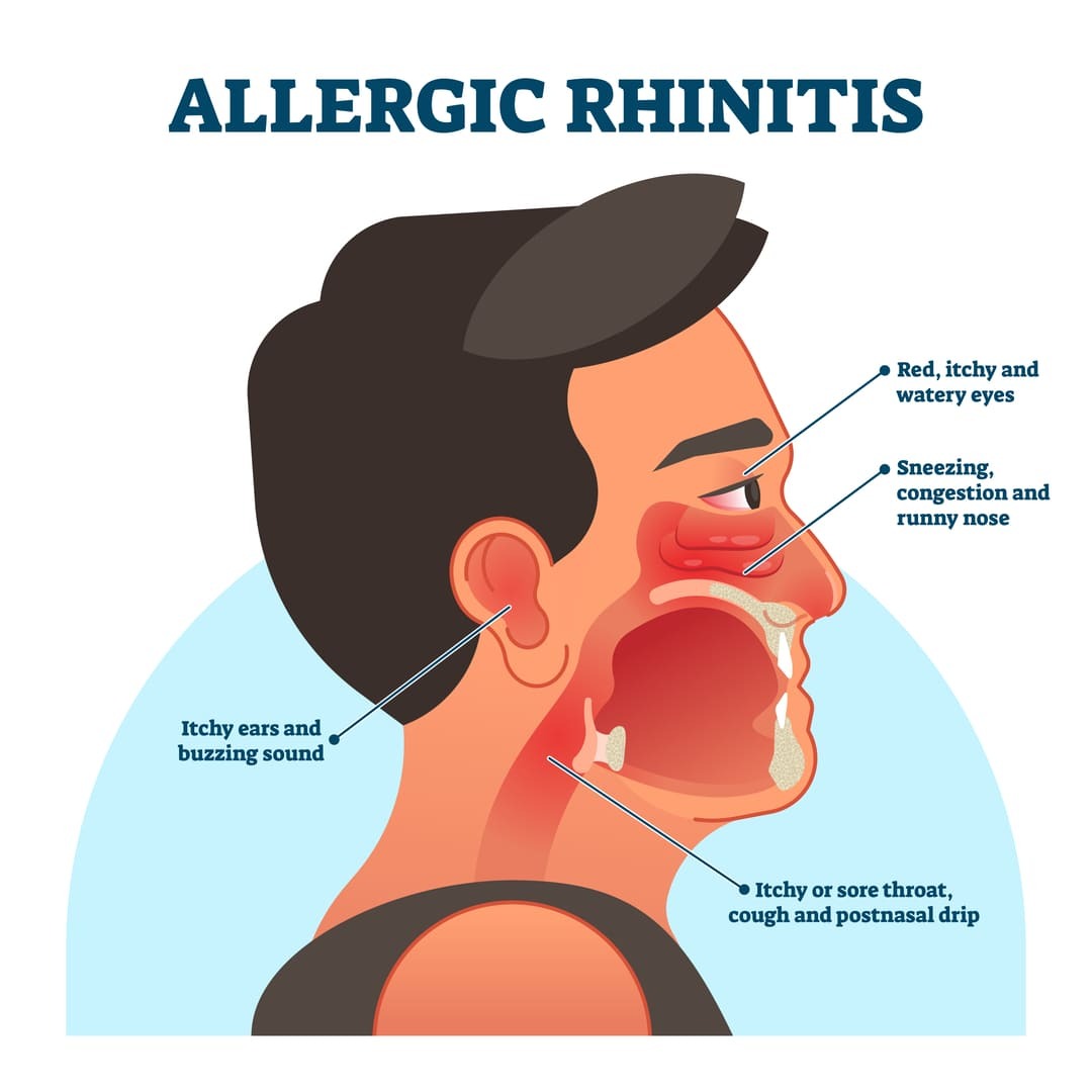 VA Secondary Conditions To Allergic Rhinitis Ultimate Guide