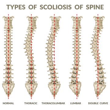 How To Get A Scoliosis Va Rating The Ultimate Guide