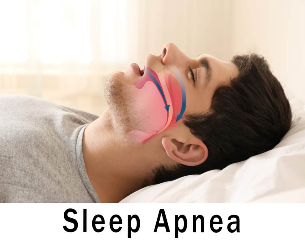 sleep-apnea-secondary-to-ptsd-it-s-time-to-start-thinking-outside-the