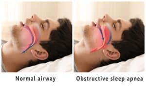 Sleep Apnea diagram