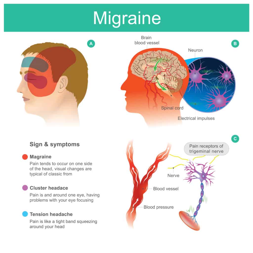 Easy VA Disability Claims #9: Migraines