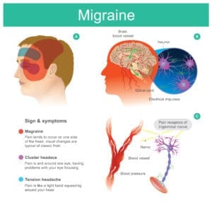 Migraine VA Claim