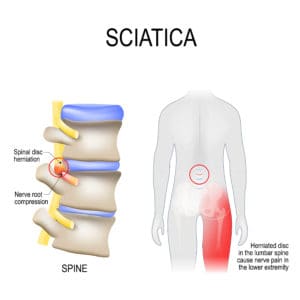 Sciatica VA Claim