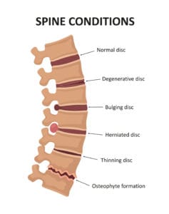 Spine VA Claim