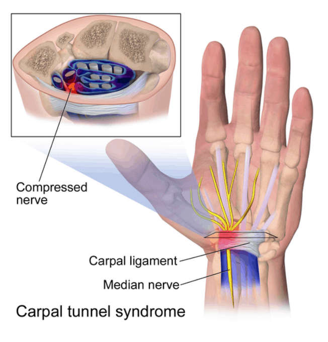 Carpal Tunnel Syndrome