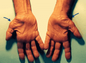Carpal Tunnel Syndrome symptoms