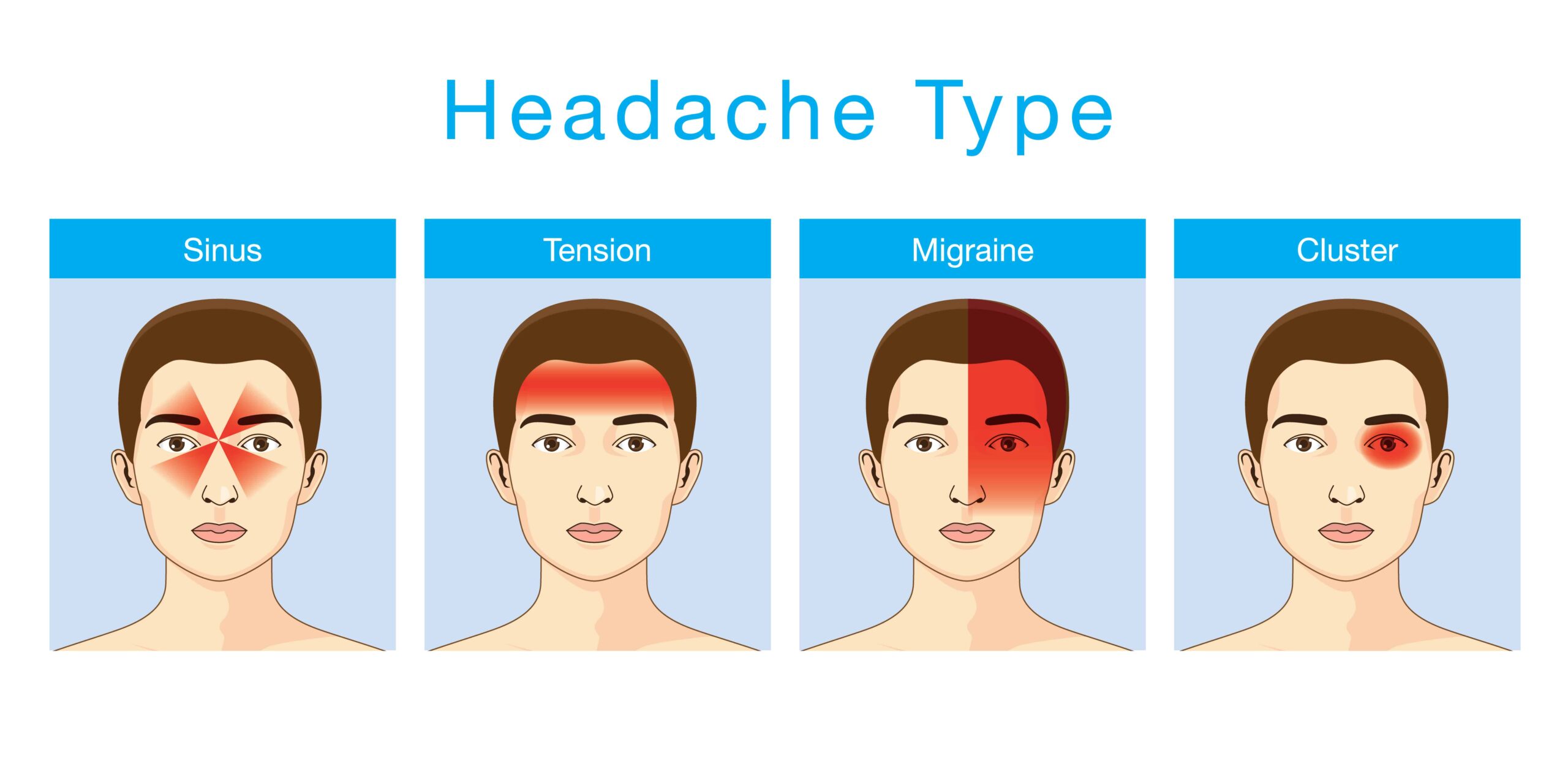 4 Types of Migraines for VA Disability 