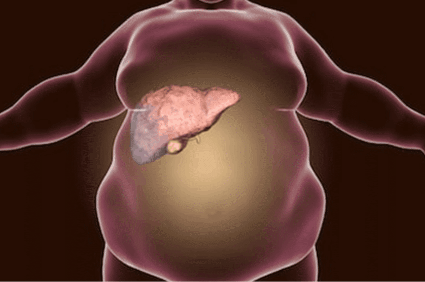 how-do-i-make-a-fatty-liver-claim-va-claims-insider