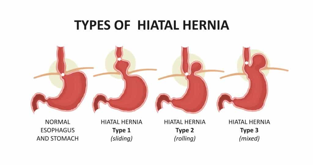 VA Rating for GERD and Hiatal Hernia