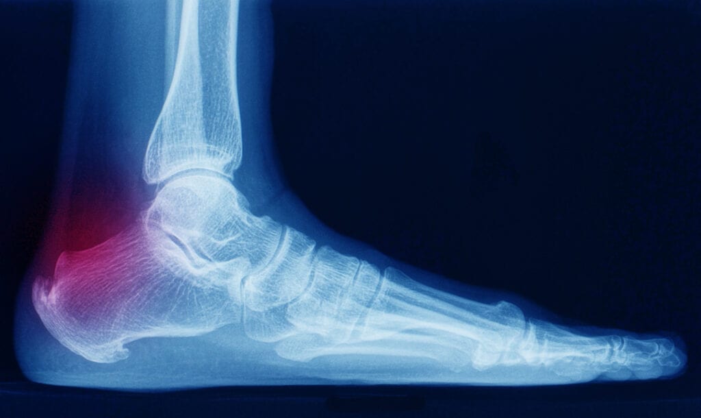 X-ray of heel spur.