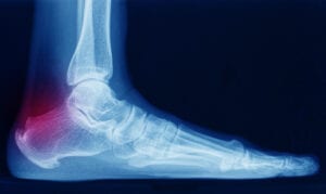How To Increase Your Plantar Fasciitis Va Rating How To Increase Your Plantar Fasciitis Va Rating
