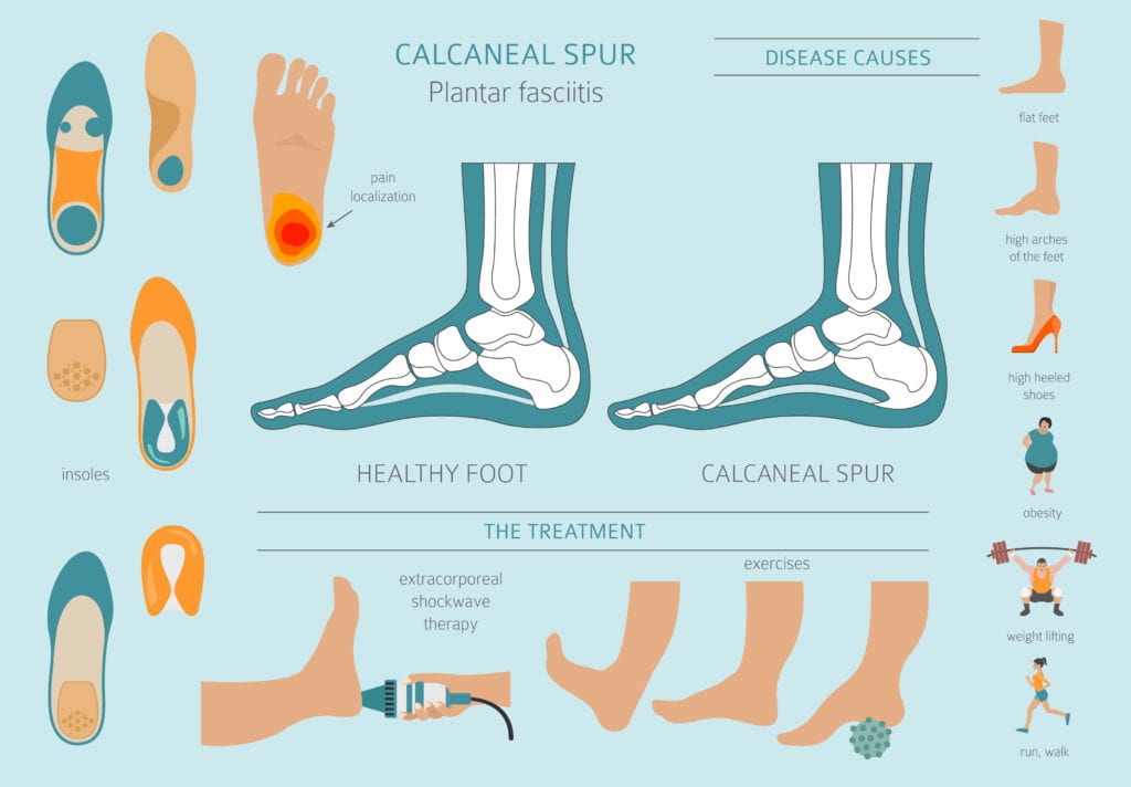 Infographic showing Plantar Fasciitis Causes and Symptoms of Heel Pain in Veterans.