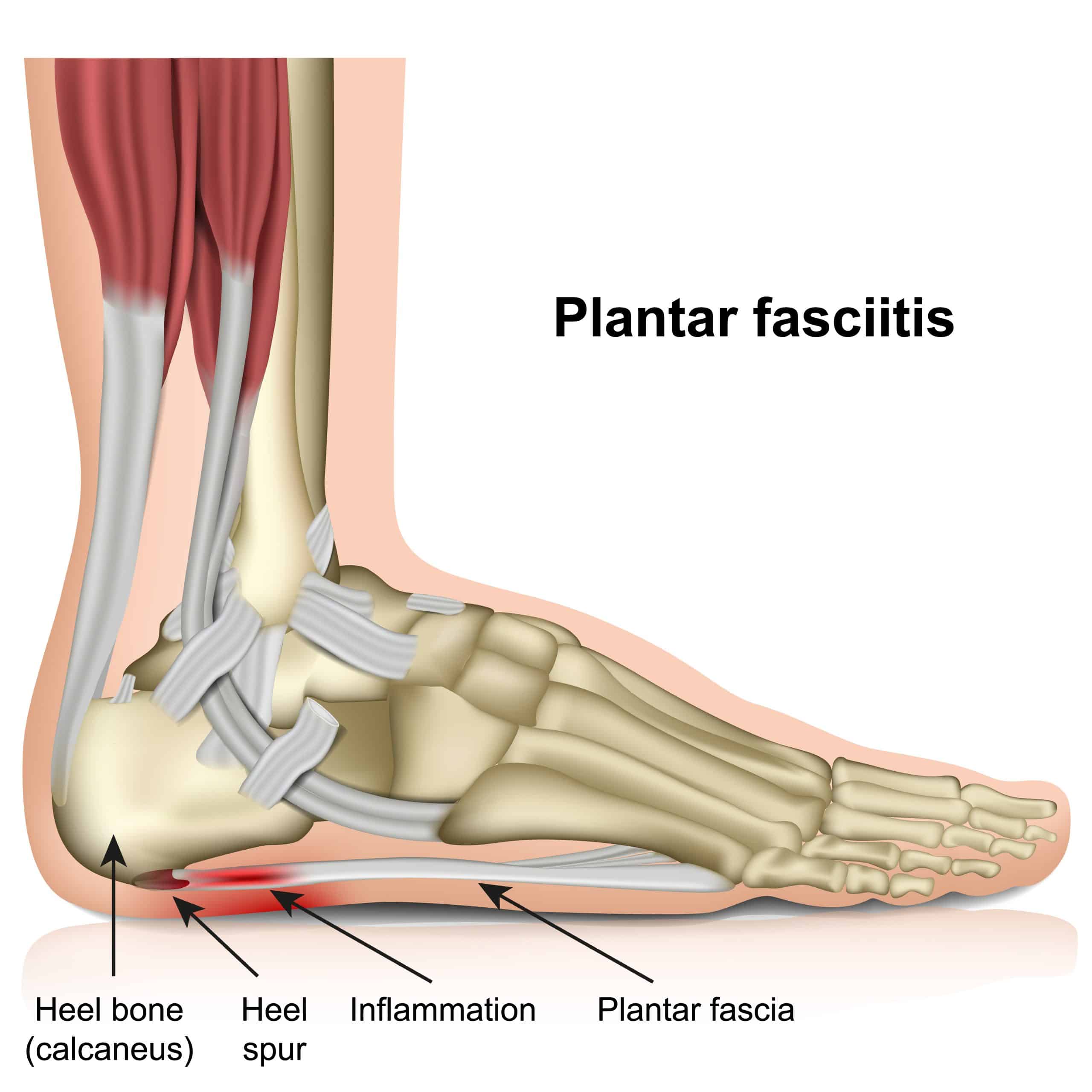 Infographic of Plantar Fasciitis.