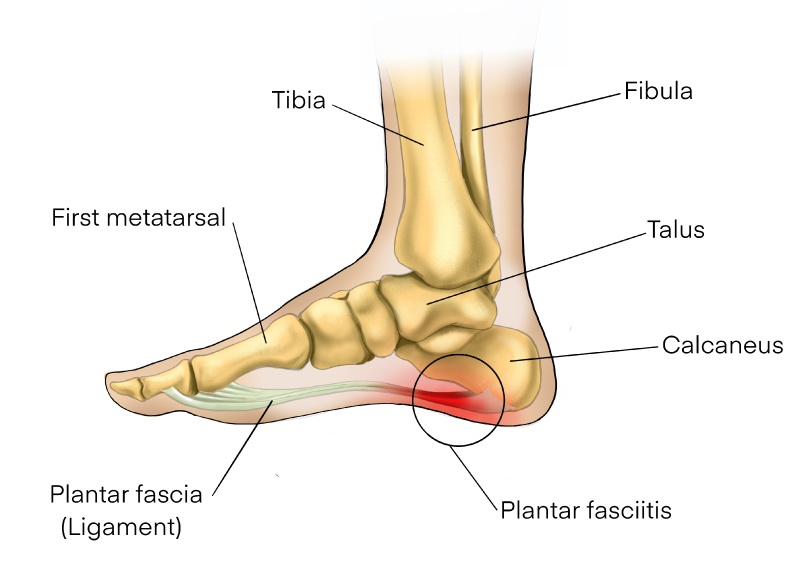 Plantar fasciitis identified on a labeled anatomical foot and ankle