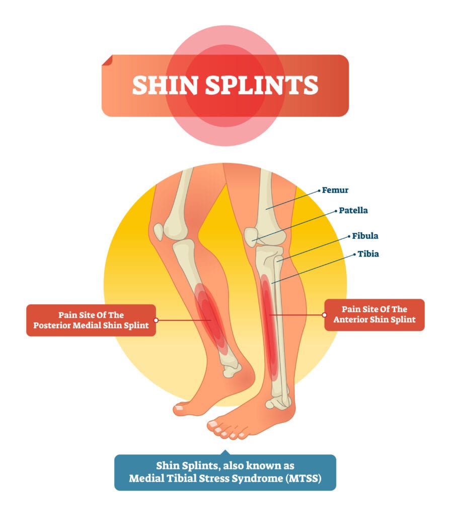 Shin Splints VA Rating