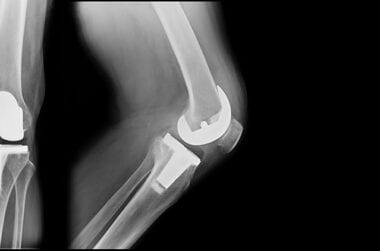 DOUBLE KNEE REPLACEMENT