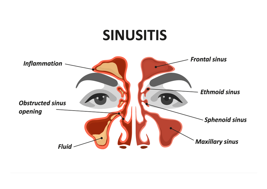 Sinusitis infographic showing the face.