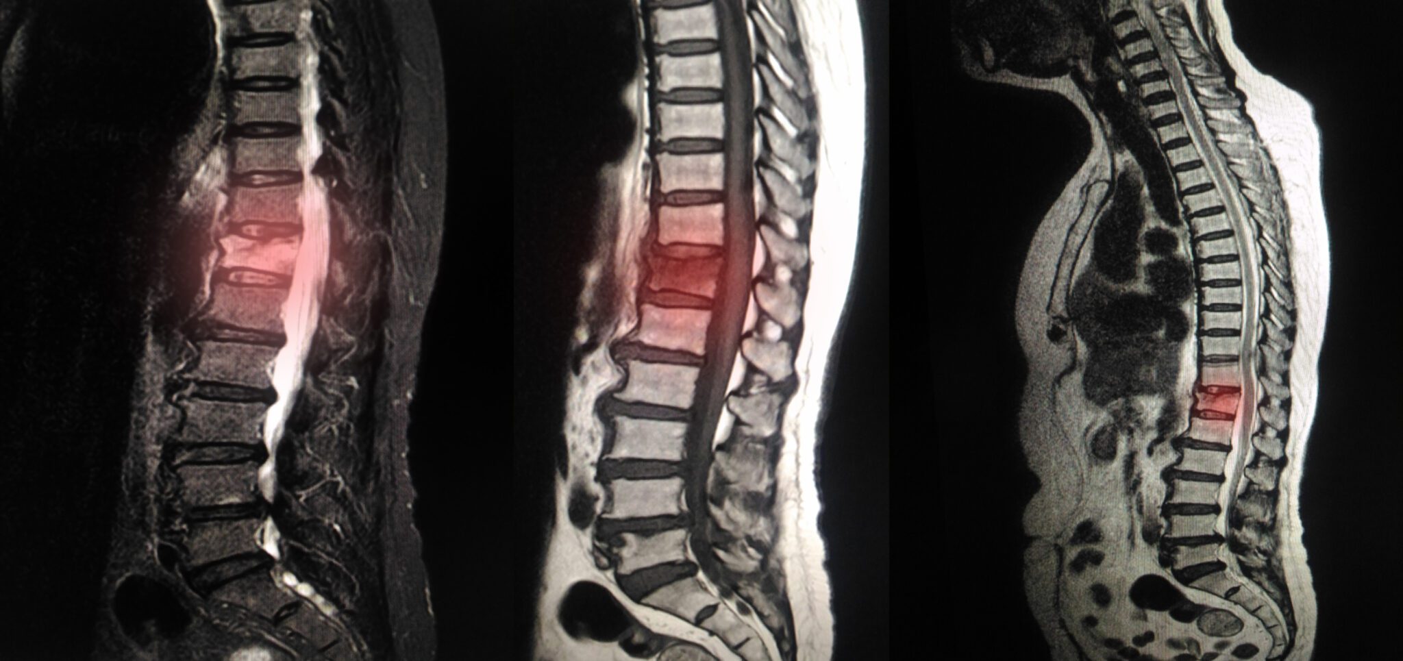 Secure a VA Disability Rating for Degenerative Disc Disease