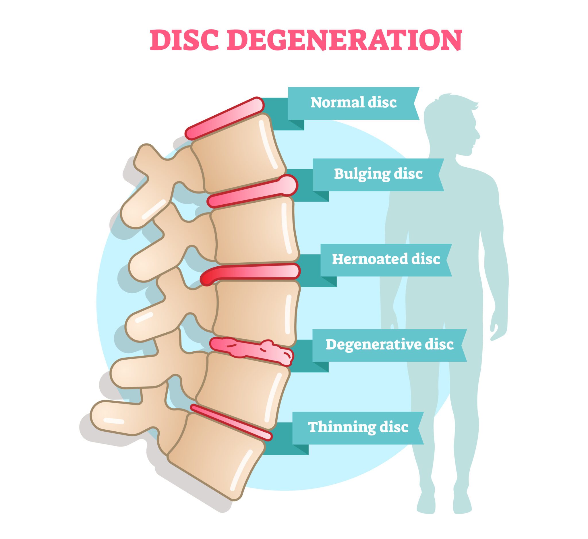secure-a-va-disability-rating-for-degenerative-disc-disease