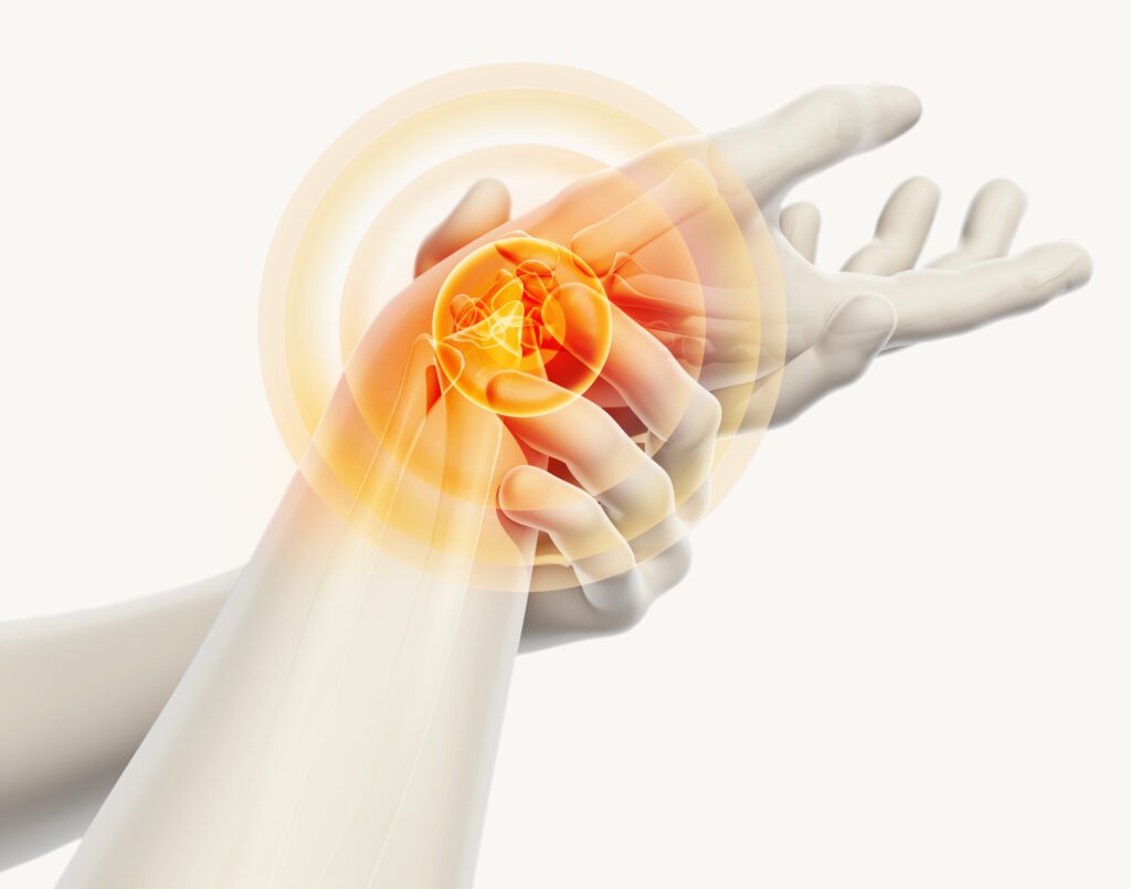 Is Carpal Tunnel a VA Disability
