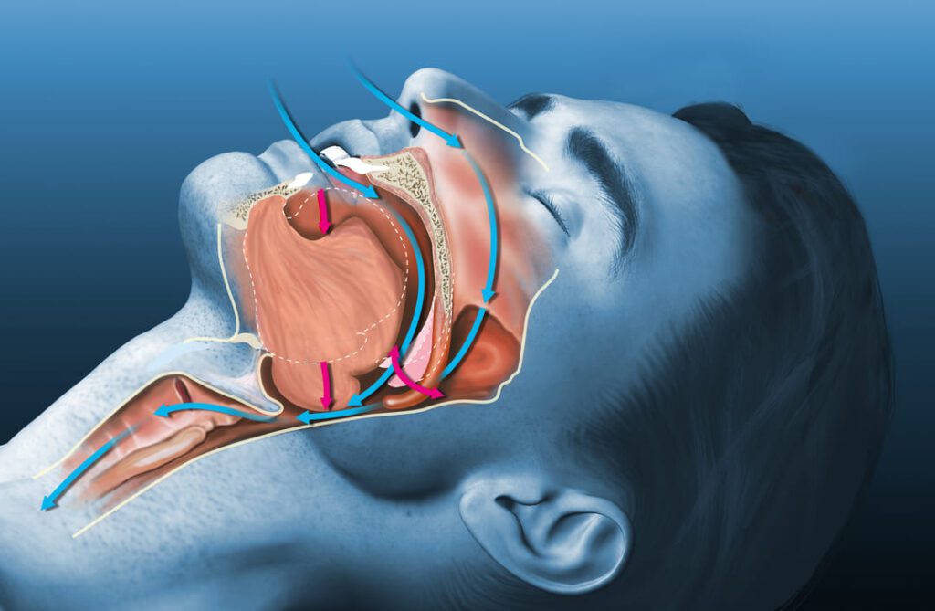 Your Sleep Apnea VA Rating — A Guide to Getting a VA Disability Rating