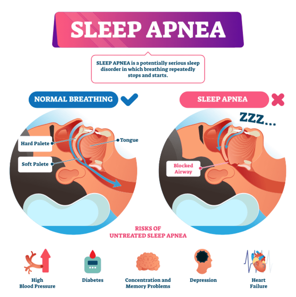 Sleep Apnea VA Ratings and Connecting Secondary Conditions