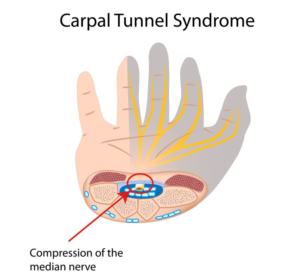 Carpal Tunnel Syndrome is #30 of the Top 30 VA Disability Claims