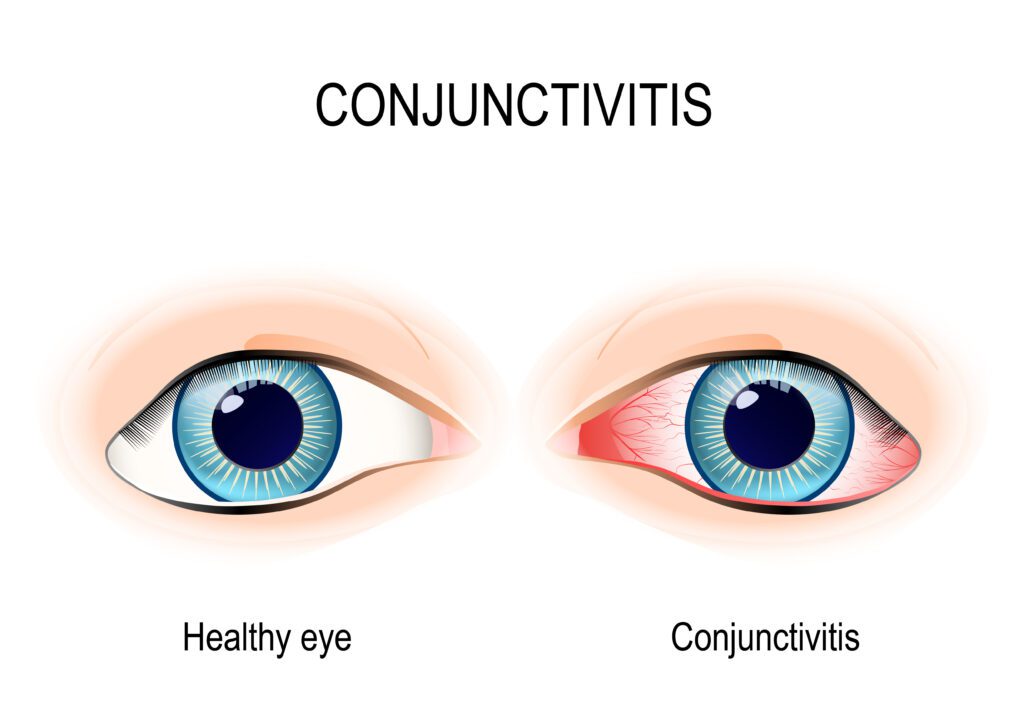 Chronic Conjunctivitis is the number 38 most claimed VA disability