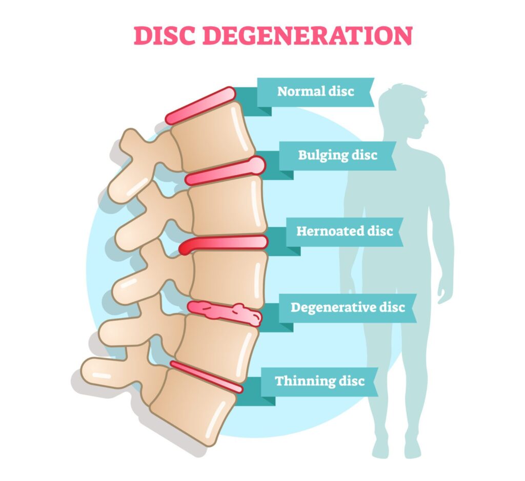 Degenerative Disc Disease or DDD is the 29 top VA disability claim