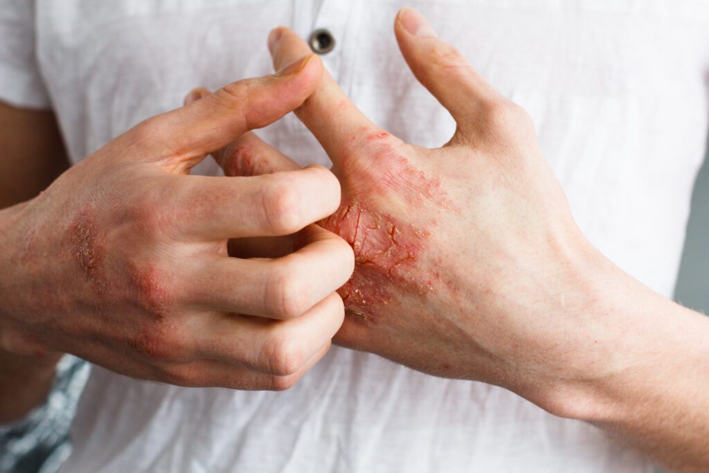 Eczema is common in veterans