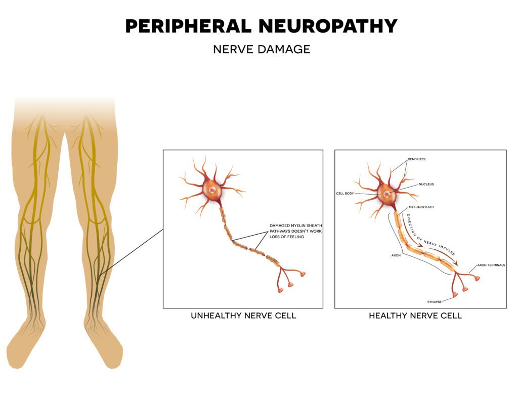 Peripheral Neuropathy is a common VA claim