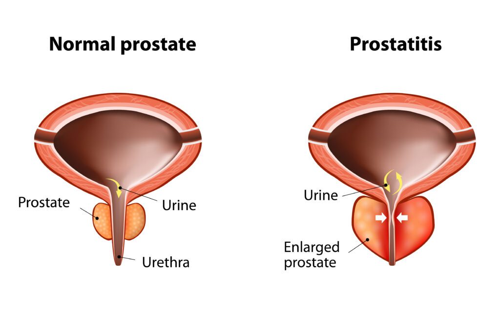Prostate Gland Injuries are common in veterans