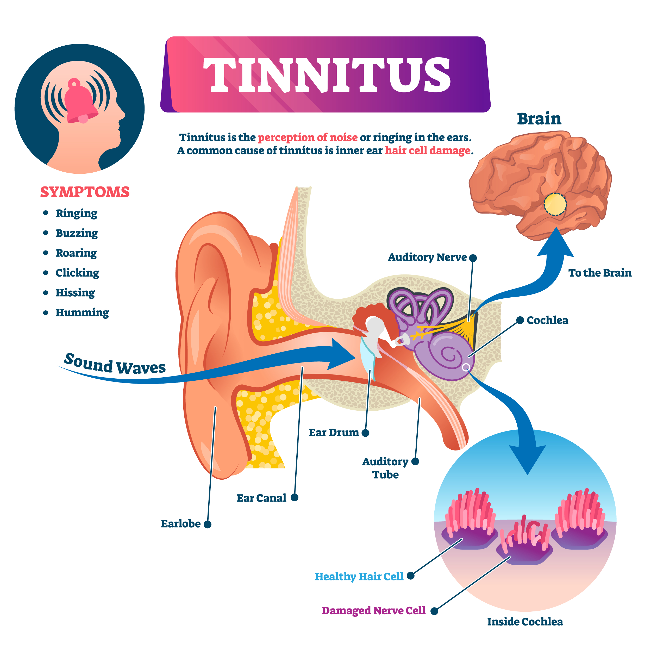 Tinnitus is the #1 top VA disability claim