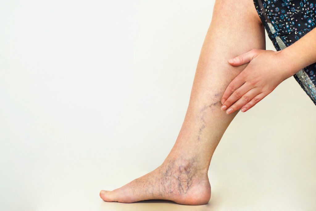 Varicose Veins are the number 42 of 50 most claimed VA disability