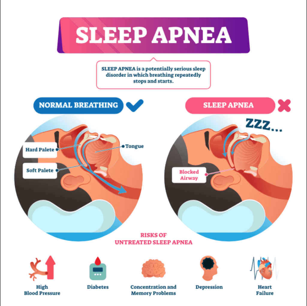 va rating for sleep apnea secondary to tinnitus