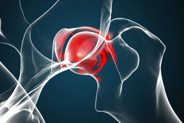 5 Best Ways to Get a VA Rating for Arthritis