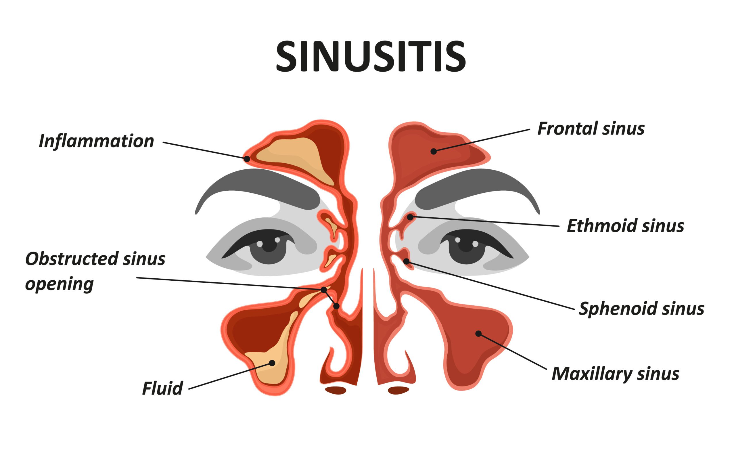 Sinusitis VA Rating Symptoms in Veterans
