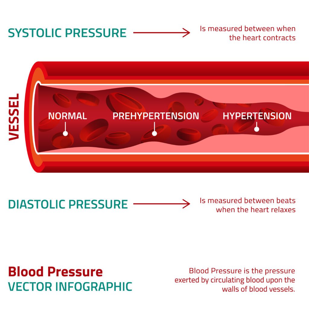 What is High Blood Pressure in Veterans