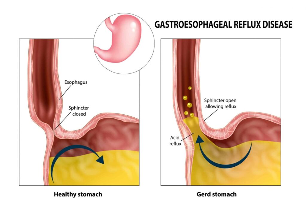 How Common is GERD in Veterans