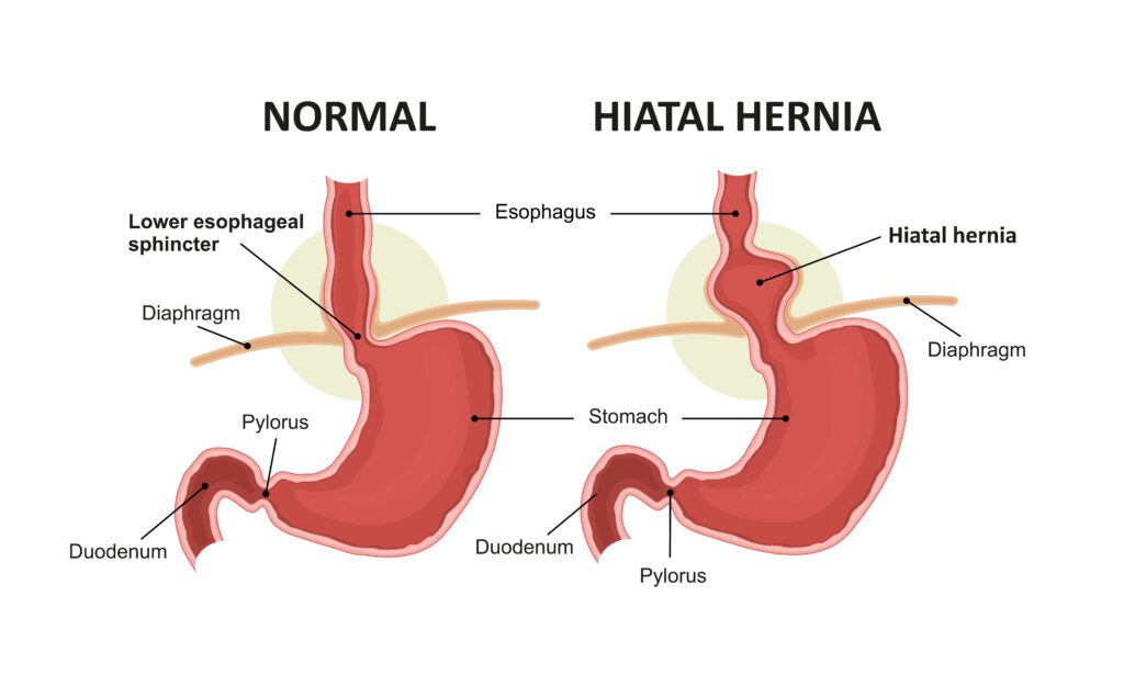 What is a Hiatal Hernia in Veterans