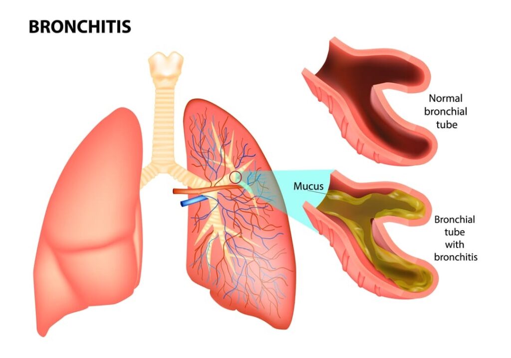 VA DISABILITY FOR SINUSITIS