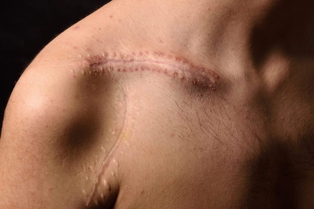 Scars are one of the easiest things to claim for VA disability