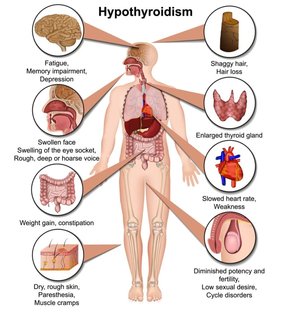 VA DISABILITY FOR HYPOTHYROIDISM