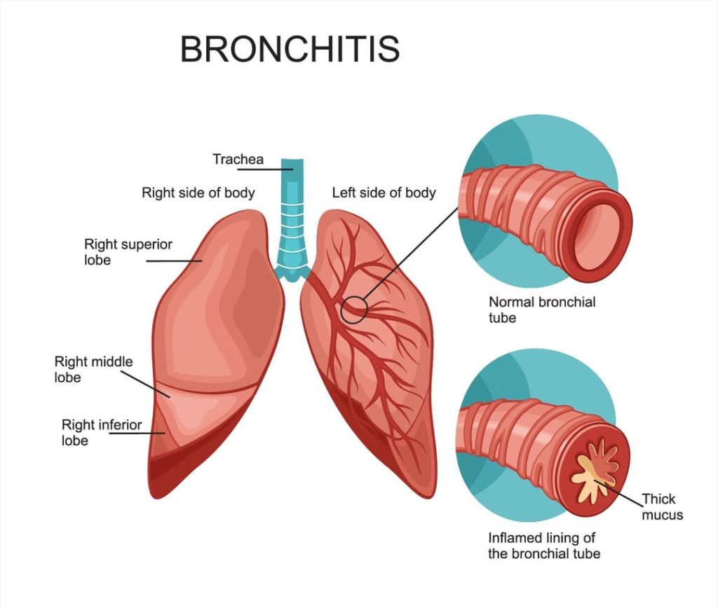 VA DISABILITY RATING FOR BRONCHITIS 1