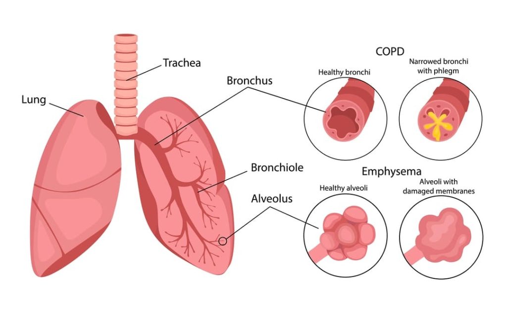 VA RATING FOR COPD