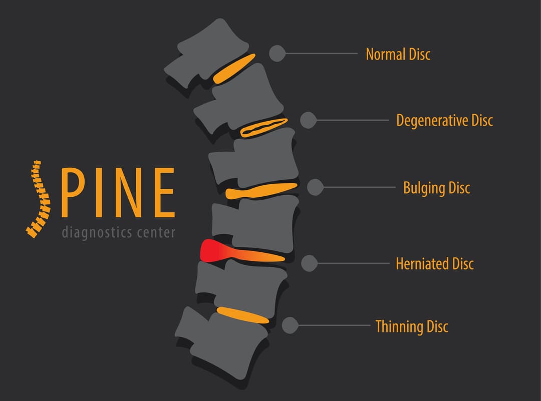 7 Things You Must Know About a Herniated Disc VA Rating (Ultimate Guide)