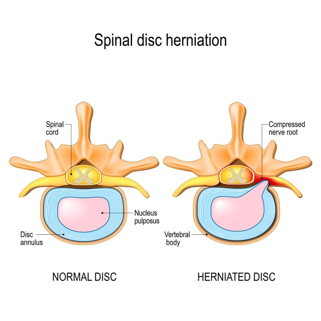 HERNIATED DISC DISABILITY PERCENTAGE