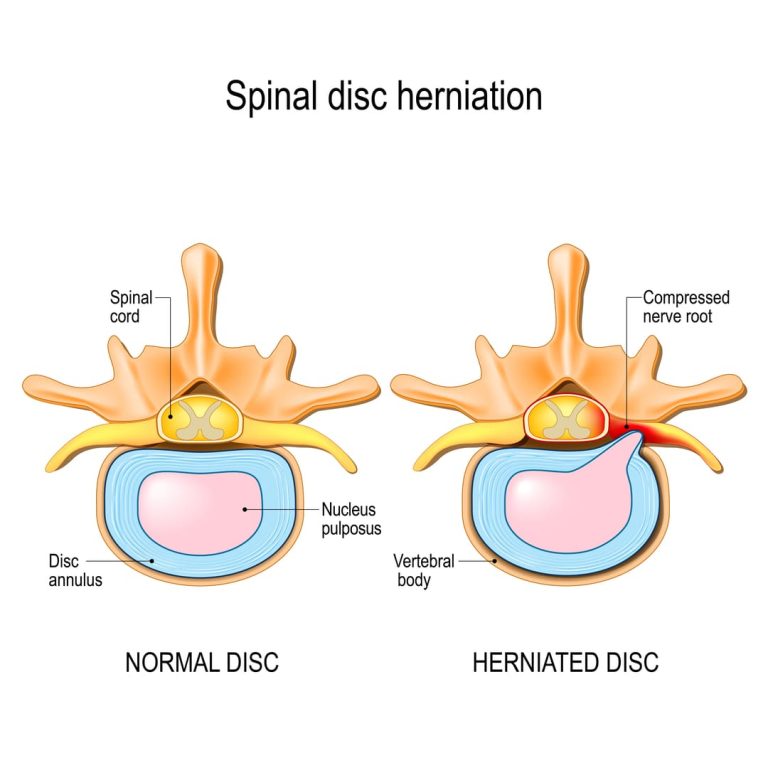 7 Things You Must Know About a Herniated Disc VA Rating (Ultimate Guide)