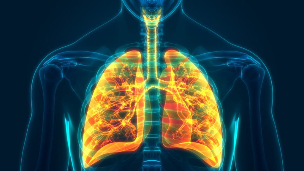 LUNG SARCOIDOSIS