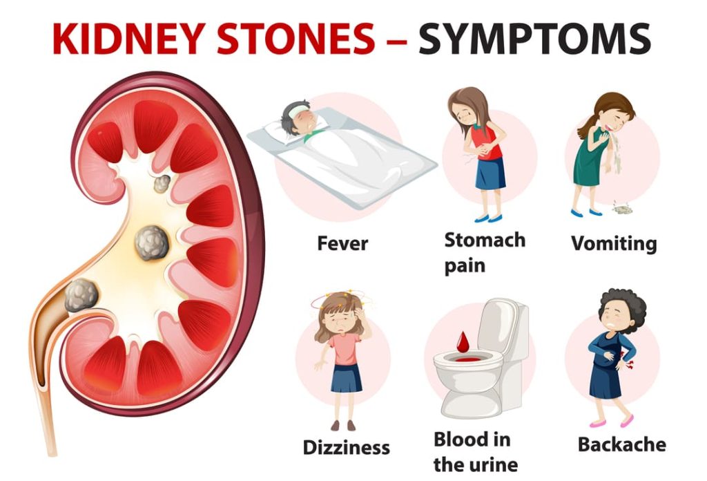 VA DISABILITY FOR KIDNEY STONES